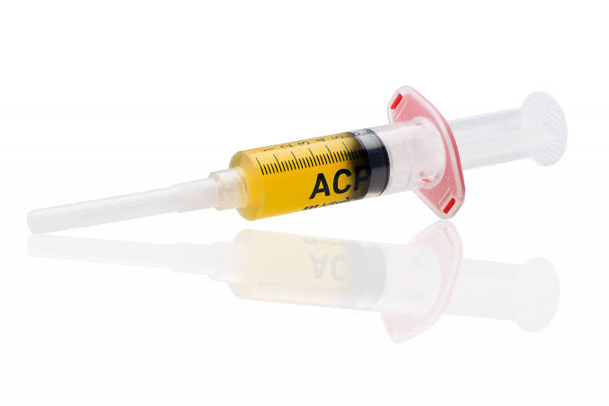 ACP syringe containing autologous plasma