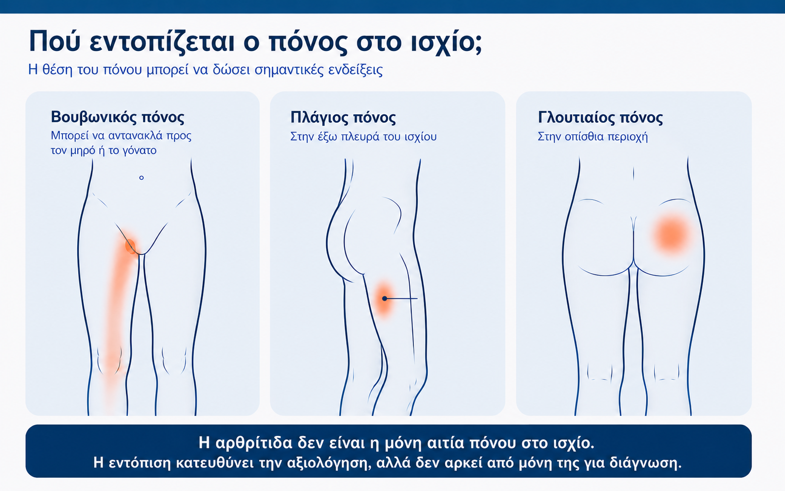 Χάρτης εντόπισης πόνου στο ισχίο: βουβωνικός, πλάγιος και γλουτιαίος πόνος